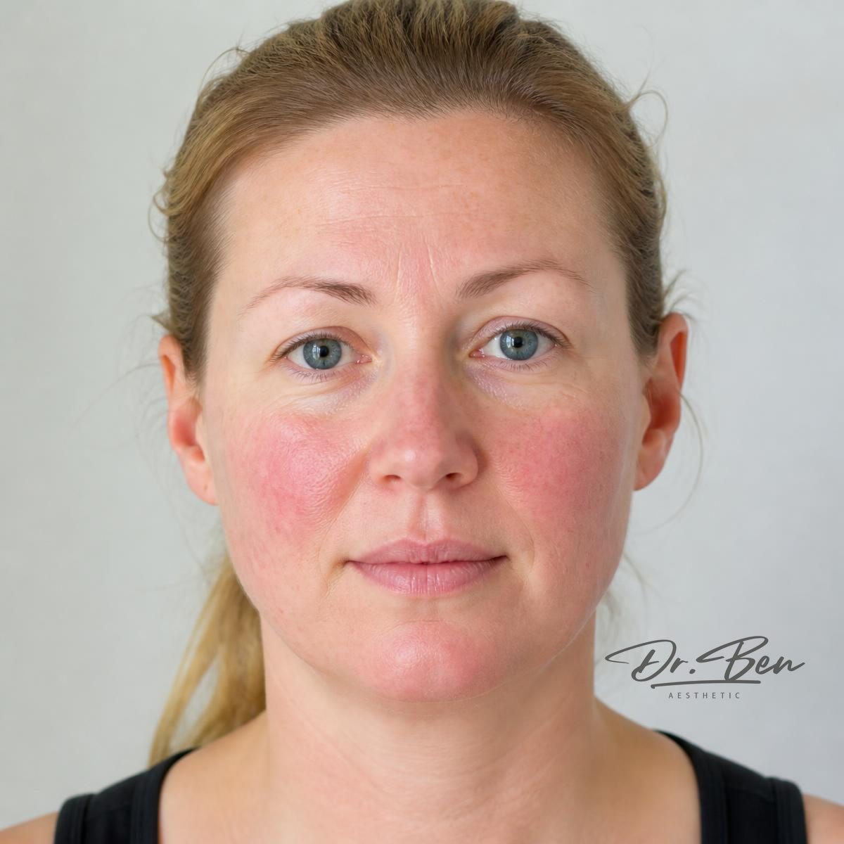 Illustrative front-facing portrait showing persistent redness across the cheeks and nose typical of mild-to-moderate rosacea, on a neutral background